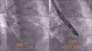 E-vita OPEN NEO total arch replacement with FET performed by Prof. Suk-Won Song and the team