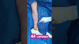 Multiple Lipoma Removal Surgery: A Transformation Journey with Dr. Neeraj Bhaban