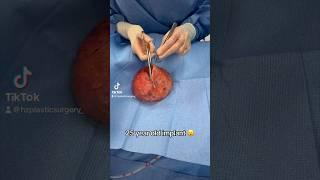 Dr. Lyly removed a 25yr old implant and cut open the surrounding capsule! Both implants were intact!