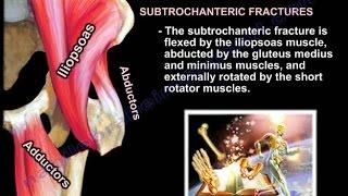 Femur fracture ,Subtrochanteric fracture - Everything You Need To Know - Dr. Nabil Ebraheim