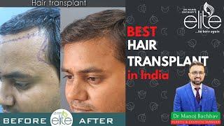 Best Hair Transplant Results in India | Dr. Manoj Bachhav - Hair Transplant in India