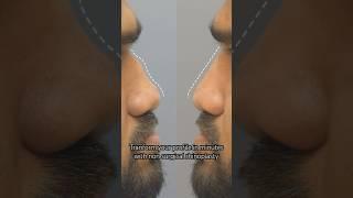 Transforming nose without surgery | Non surgical rhinoplasty at Cara