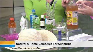 Natural and home remedies for sunburns