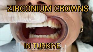 Zirconia Crowns Turkey - Cosmetic dentistry in Turkey @Golden Smile Dent