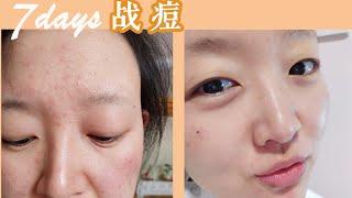 7天战痘早晚护肤Routine分享！全程素颜预警 | Weekly Skincare Vlog