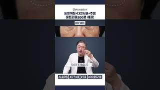 눈밑꺼짐+다크서클+주름, 단 하나의 시술로 전부 해결할 수 있습니다(Solution that can solve all the aging under your eyes)#shorts