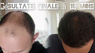 greffe de cheveux, résultat final à15 mois, parlons du finastéride, du minoxidil , dermopigmentation