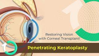 Penetrating Keratoplasty: Full-Thickness Corneal Transplant Explained | One Clinic Istanbul