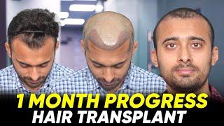 Hair Transplant in Ahmedabad | Best Results & Cost of Hair Transplant in Ahmedabad