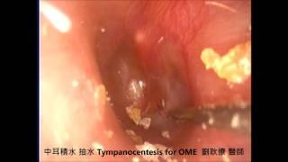 中耳積水 中耳炎 抽水  OME tympanocentesis