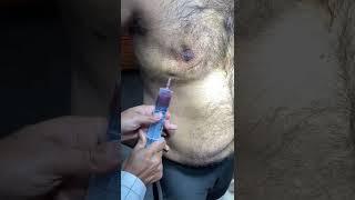 Seroma after gynecomastia . What to do सिरोमा