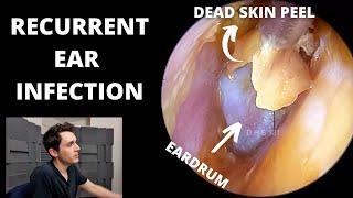 Stripping Dead Skin From Infected Ear (Prostaglandins Discussed)