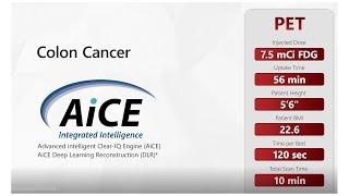 AiCE for PET Clinical Example - Colon Cancer