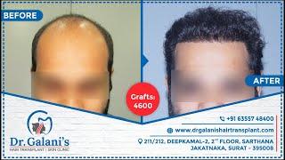 Best Hair Transplant In Surat 2021 | Fue - No Root Touch Surgery | Before And After 4600 Grafts