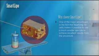 What is SmartLipo?