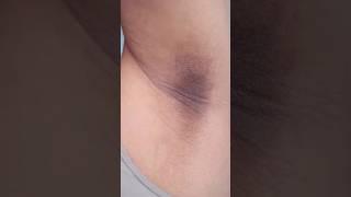খুব সহজেই Underarms এর কালো দাগ দূর করুন