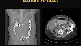 CT Artifacts Patient-based Artifacts