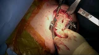 Exactech Anatomic Total Shoulder Replacement Using Preserve Stem and Cage Polyethylene Glenoid