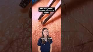 Pili multigemini… What is it?!  Dr. Brown Explains #shorts #dermreacts #doctorreacts #ingrownhair