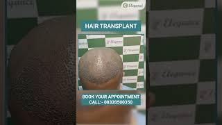 Hair Transplant Treatment | Hair Regrowth, Hair Baldness in Vesu, Athwagate, Surat