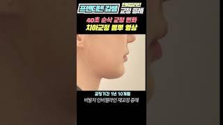 40초 30대 여자 인비절라인 재교정 [비발치, 뻐드렁니, 돌출입교정 치아교정 전후 변화 순삭영상]