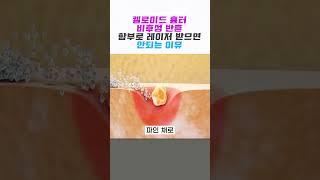 켈로이드 흉터레이저 치료️함부로 받으면 안되는 이유 (feat. 여드름 닥터)
