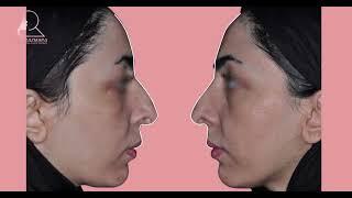 عمل بینی غضروفی استخوانی با انحراف تیغه بینی