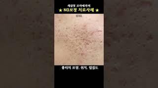 #흉터읽어주는한의사 #새살침후기 #새살침한의원 #부산흉터치료 #코라테라피 #여드름흉터없애는방법 #여드름흉터치료 #박스카 #아이스픽 #롤링 #모공성흉터 #로담한의원부산 #shorts