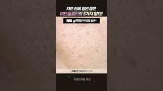 #여드름흉터 #박스카흉터 #롤링형 #아이스픽 #여드름흉터제거 #여드름흉터치료