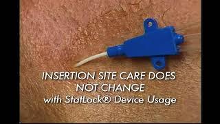 StatLock CV Plus Stabilization Device Application Procedure Video