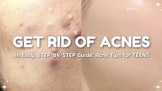 how to get rid of pimples  acne tips for clear skin for teens | TheGlamourGuild