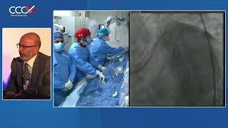 Live Case 3 - IVUS Guided Mini-Crush of LAD/D1 Bifurcation