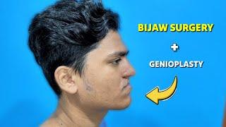 Bijaw Orthognathic Surgery for Depressed Upper Jaw | Dr Parit Ladani