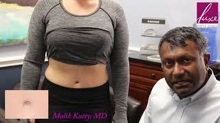 Ingenious idea for healing a tummy tuck bellybutton!