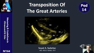 Transposition of the great arteries (TGA)