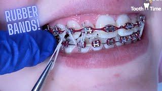 Braces On - Rubber Bands Check ups - Tooth Time Family Dentistry New Braunfels Texas