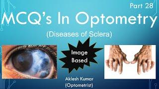 MCQ's in Optometry | Diseases of Sclera | part 28