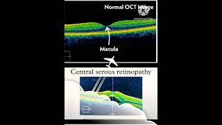 Normal oct vs Abnormal oct retina #shortvideo #viral #knowledgewithani