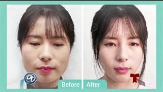 Kybella® Fat Dissolving Injection