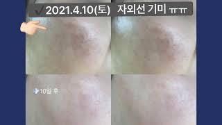 #기미에좋은화장품 #미백세럼리얼후기#아마란스화장품 #자외선노출기미 미백세럼10일사용 후 효과