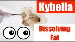 1cc of Kybella Dissolving Fat Demonstration - Dr. Weiner