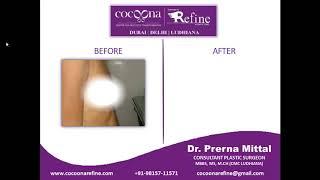 Gynecomastia | Male Breast Reduction In Ludhiana,Punjab-Dr. Prerna Mittal-9815711571