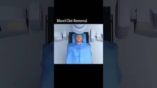 Niazi Education and Learning | Blood clot Removal