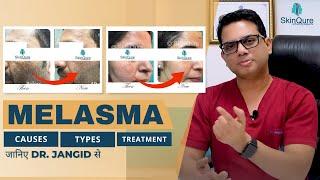 All About Melasma | Causes, Types and Treatment options | जानिए Dr. Jangid से (हिंदी में) | SkinQure