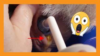 Dr. Gawayne Ear Cleaning | Auburn Medical Group