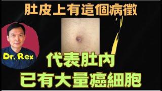 (中英字幕EngSub) 肚皮上出現這個病徵，代表癌症晚期！Watch out for this bump on the belly button it may mean cancer