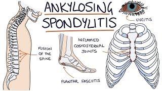 Ankylosing Spondylitis: Visual Explanation for Students