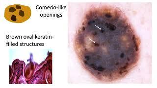 Seborrheic keratosis and solar lentigo - Dr Cristian NAVARRETE-DECHENT