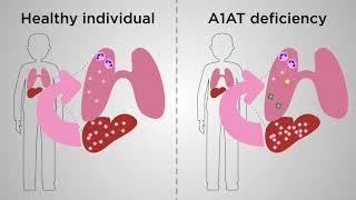 An ultimate mouse model of gene therapy for ﻿alpha-1 antitrypsin deficiency