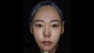 짧은 얼굴 만들기 30대 실시간 리얼 비교 시술 얼굴 반쪽만 시술해봤어요